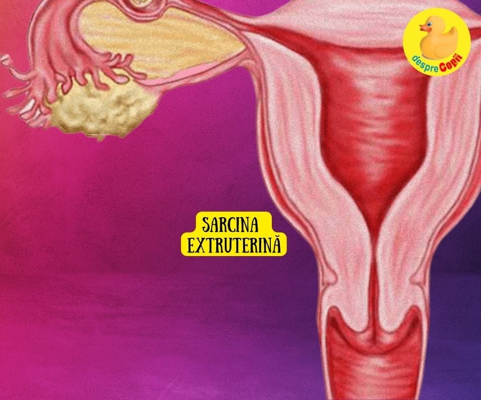 Sarcina extrauterină: 6 cauze POSIBILE explicate de medicul ginecolog