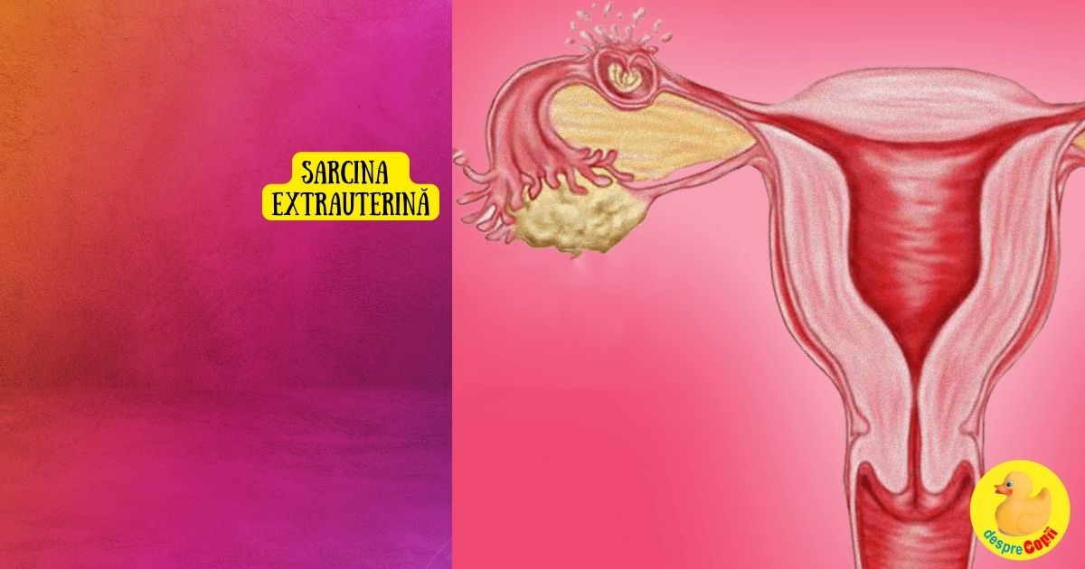 Sarcina extrauterina - 6 cauze posibile explicate de medicul ginecolog width=