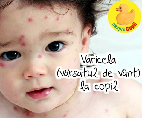 Varicela (varsatul de vant) la copil -  simptome, complicatii, tratament - sfatul medicului