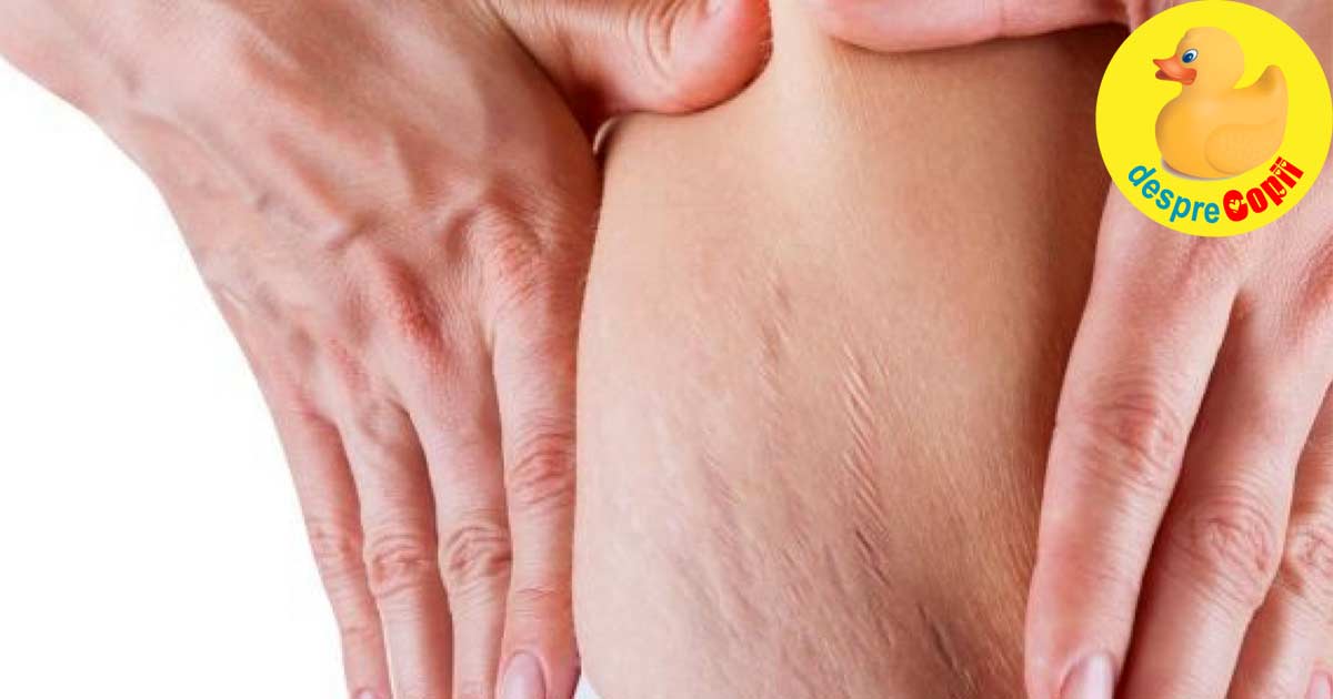 Vergeturile: 3 moduri naturale pentru a te proteja de ele